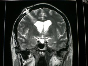 neuroendoscopia neurochirurgo a Napoli Dott Claudio Schonauer 2